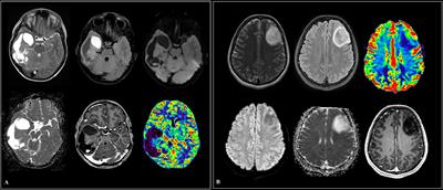 Circulating miRNAs as Diagnostic and Prognostic Biomarkers in <mark class="highlighted">High-Grade Gliomas</mark>
